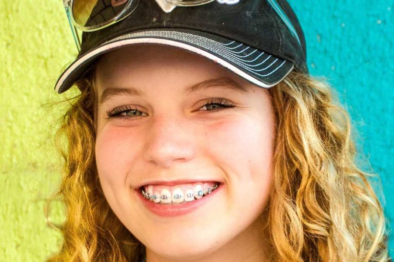 rodzaje-aparatów-ortodontycznych