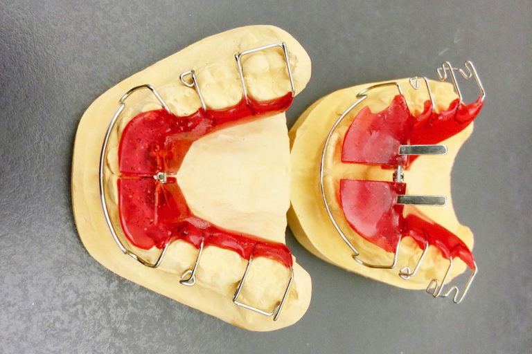 w-jakim-wieku-mozna-zakładać-aparat-ortodontyczny
