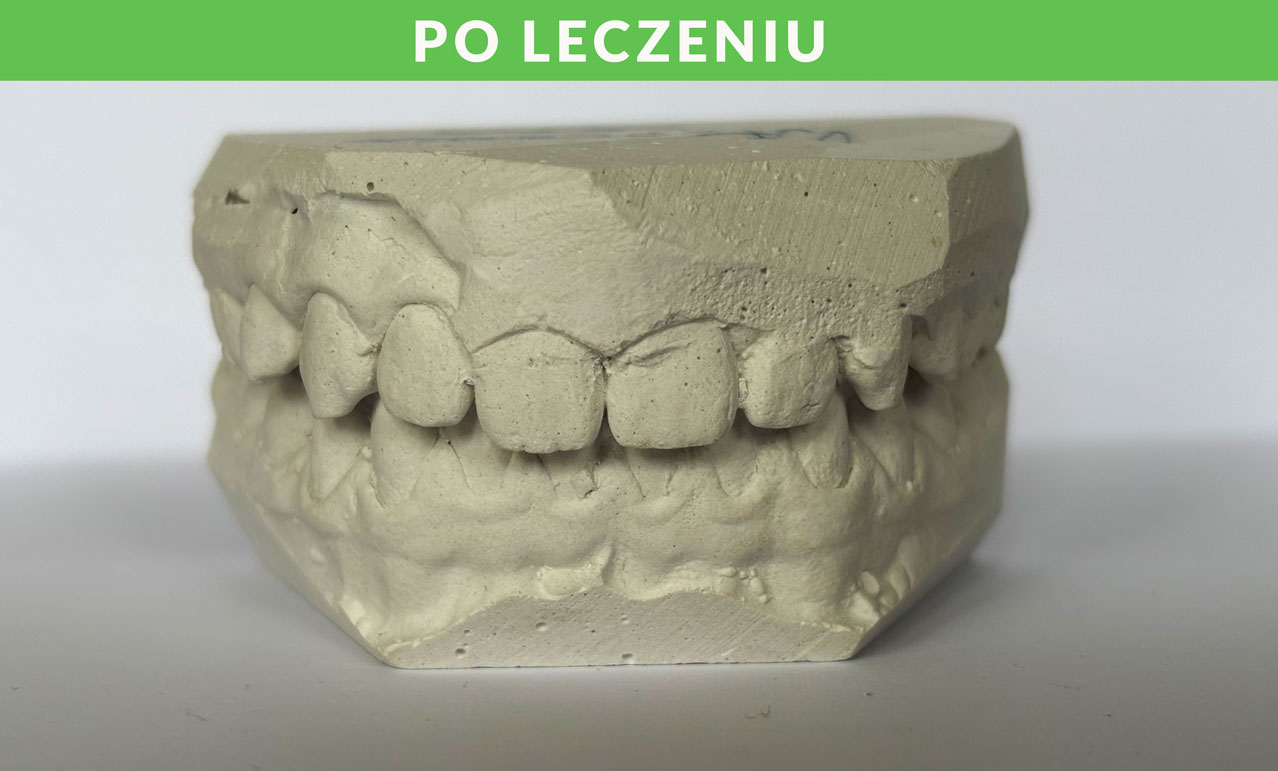 PO-LECZENIU